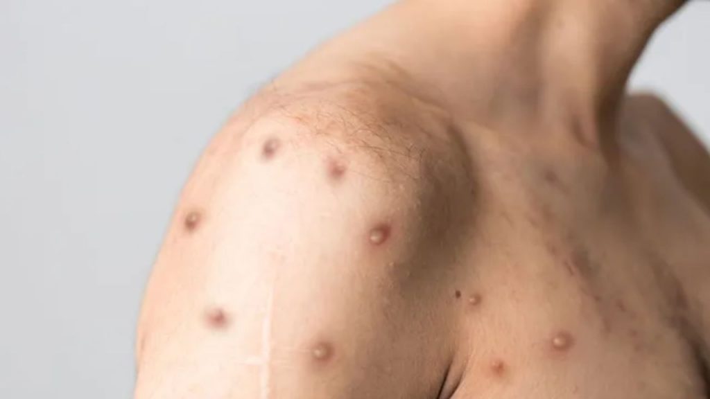 Brote de viruela del mono en Galicia confirma 9 casos sin origen claro. Sanidad activa vigilancia, recomienda aislamiento, vacunación y precauciones para frenar la expansión.